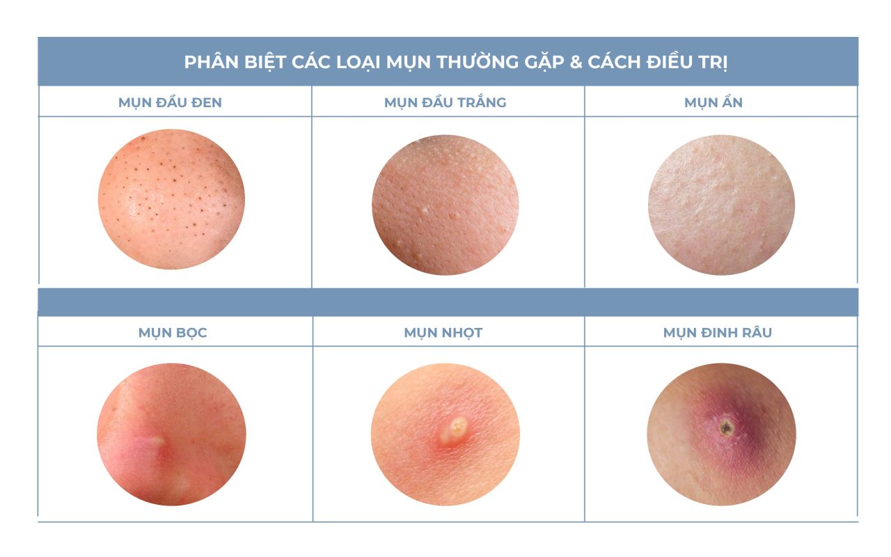 Phân Biệt Các Loại Mụn Trên Mặt Và Giải Pháp Điều Trị Hiệu Quả
